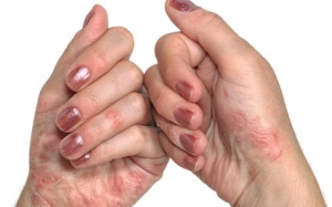 Những loại thực phẩm dễ làm tái phát bệnh vẩy nến