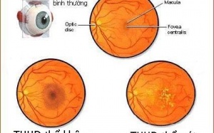 Cách phát hiện bệnh thoái hóa điểm vàng