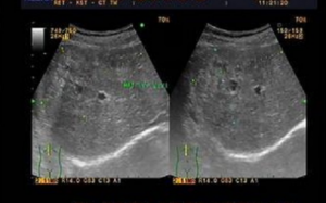 Cắt 1/4 gan vì tưởng khối u mới biết do sán làm tổ