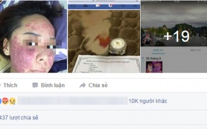Mặt xuất huyết tím đen vì dùng kem trị mụn mua qua facebook