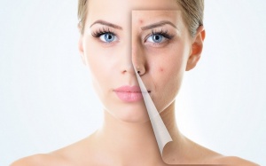 Nguyên nhân không ngờ gây mụn trứng cá