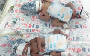 Cứu thành công cặp song sinh mới 28 tuần tuổi