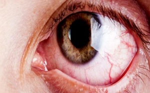 Viêm màng bồ đào dễ nhầm với đau mắt đỏ