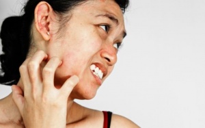 5 dấu hiệu của bệnh lupus mà bạn cần lưu ý