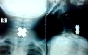 Dị vật hình chữ thập chắn ngang thực quản bé 3 tuổi