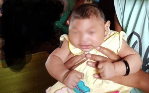 Nghi bé gái mắc chứng đầu nhỏ do Zika 