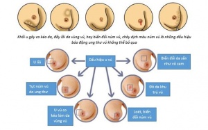 Tự kiểm tra vú - Cơ hội chữa lành ung thư vú