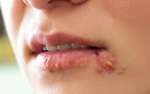 5 các tự nhiên chữa mụn rộp ngay tại nhà