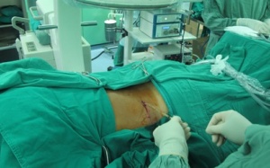 Sợ phẫu thuật, bệnh nhân bị “tảng” sỏi san hô lấp đầy thận