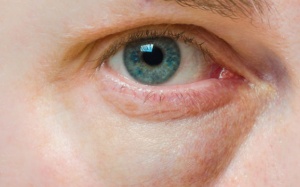 Mắt sưng sau 24h không khỏi là dấu hiệu bệnh nguy hiểm