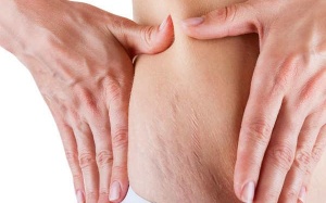 7 sự thật đáng ngạc nhiên về rạn da