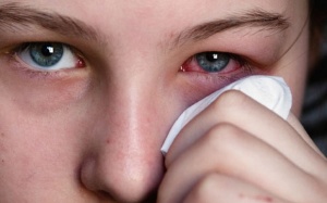 Những dạng viêm kết mạc phổ biến và cách xử lý