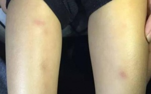 Đặt bút ghi âm, phát hiện cô giáo mầm non đâm kim vào người con