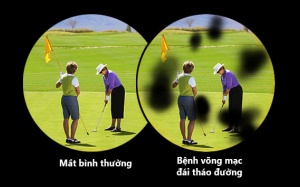 Bệnh mắt vì đái tháo đường: Bổ sung omega-3 có ăn thua?