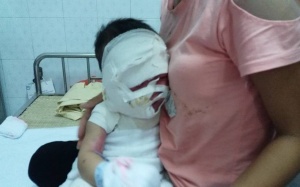 Mẹ sơ sẩy, con trai 11 tháng tuổi bị cả ấm nước siêu tốc đổ từ đầu xuống chân