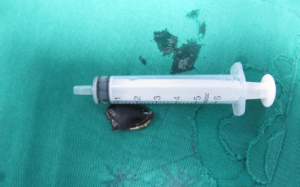 Ho 4 năm mới phát hiện hạt hồng xiêm trong phế quản