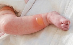 Chuyên gia hướng dẫn cách sơ cứu trẻ bị bỏng