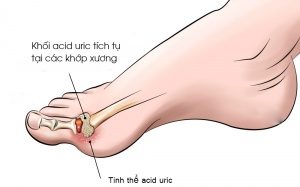 Các biện pháp tự nhiên giúp giảm acid uric