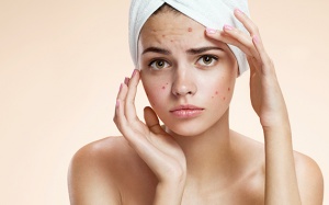 Một số giải pháp tự nhiên giúp trị mụn nhanh chóng 