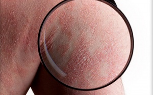 Tinh dầu có giúp hỗ trợ điều trị vẩy nến?