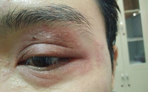 Sốt cao, bội nhiễm da vì kiến ba khoang đốt