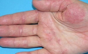 Làm gì khi bị viêm da cơ địa?