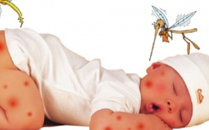 Vết muỗi đốt sưng to có nguy hiểm?