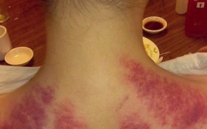 Cạo gió chữa cảm lạnh cần lưu ý