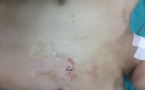 Cứu bệnh nhân bị tràn máu, tràn khí màng phổi do dao đâm