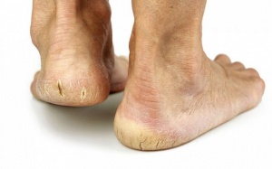 Trị nứt gót chân vào mùa Đông bằng những cách đơn giản