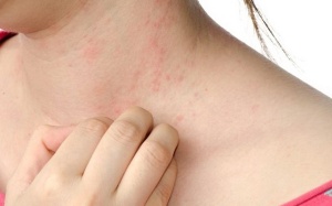 Nhỏ không bị dị ứng thực phẩm, lớn lên bị dị ứng do đâu?