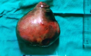 Bật mí phương pháp khiến khối u xơ to như quả bưởi 'tự rụng'