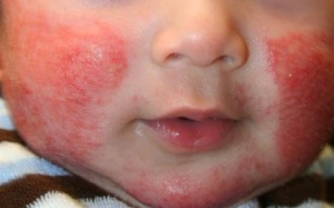 Bé bị đỏ da, mẩn ngứa trên mặt do đâu?
