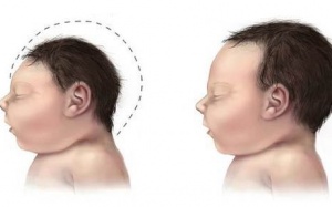 Những thủ phạm gây dị tật đầu nhỏ ở thai nhi: Làm sao phát hiện và dự phòng?