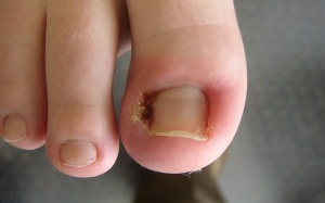 Móng chân mọc ngược vào trong điều trị thế nào?