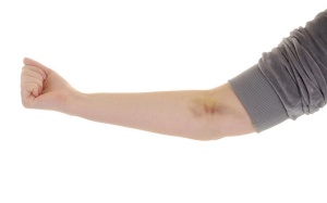 7 nguyên nhân khiến da hay bị bầm tím, chảy máu