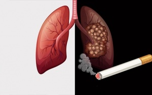 Ung thư phổi: Liệu bạn có nguy cơ mắc bệnh?