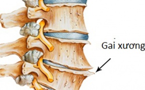 Gai cột sống và những quan niệm sai lầm trong điều trị