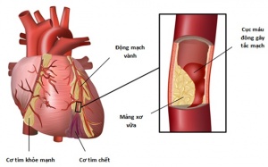 Cholesterol - Thủ phạm gây xơ vữa động mạch