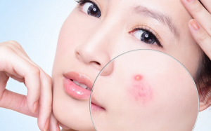 Da nổi mụn có nên trang điểm hay dùng kem dưỡng ẩm?