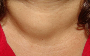 U tuyến giáp đa nhân lành tính phải làm sao?