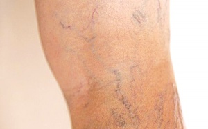 Dành 15 phút mỗi ngày phòng bệnh suy tĩnh mạch