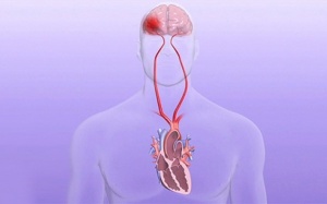 Người bệnh rung nhĩ bị tăng huyết áp cần cẩn thận nguy cơ đột quỵ