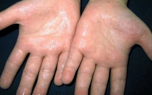 Tại sao lại bị ra mồ hôi chân, tay vào mùa Đông?