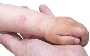 10 biện pháp tại nhà giúp bạn đối phó với bệnh eczema