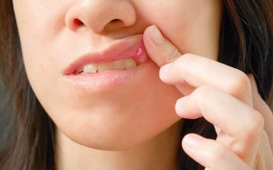 Chữa loét miệng chỉ trong 2 ngày bằng 2 thành phần tự nhiên