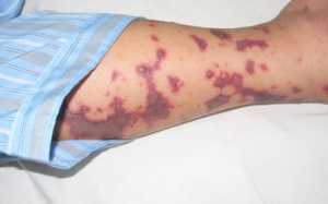 Hà Nội: Xuất hiện ca bệnh não mô cầu ở kí túc xá