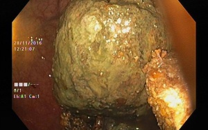 Tắc ruột sau khi ăn 3 quả hồng giòn