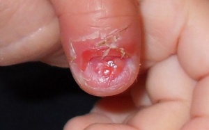 Sau bao lâu móng tay, móng chân bị bật có thể mọc lại?