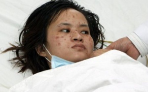 Bệnh viêm não mô cầu nguy hiểm như thế nào